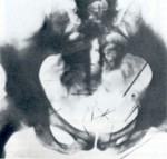 Albert Fish Pelvis with needles